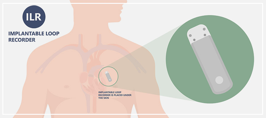 Implantable Loop Recorder Near Me In Downey CA